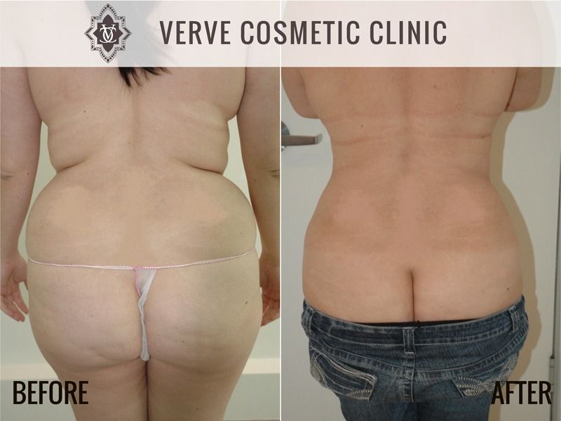 Liposuction Sydney to Improve Your Appearance