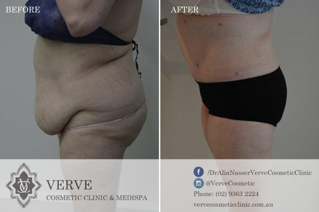 Tummy Tuck (Abdominoplasty)